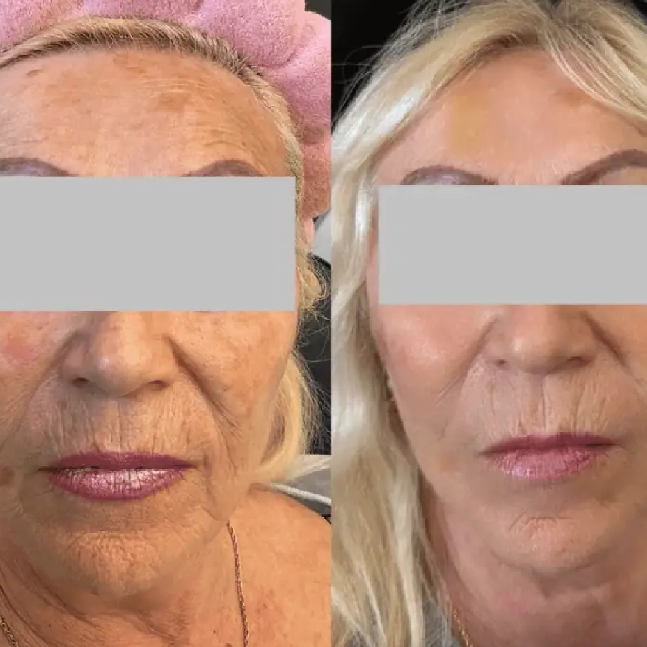 Aerolase® Neo Laser 2