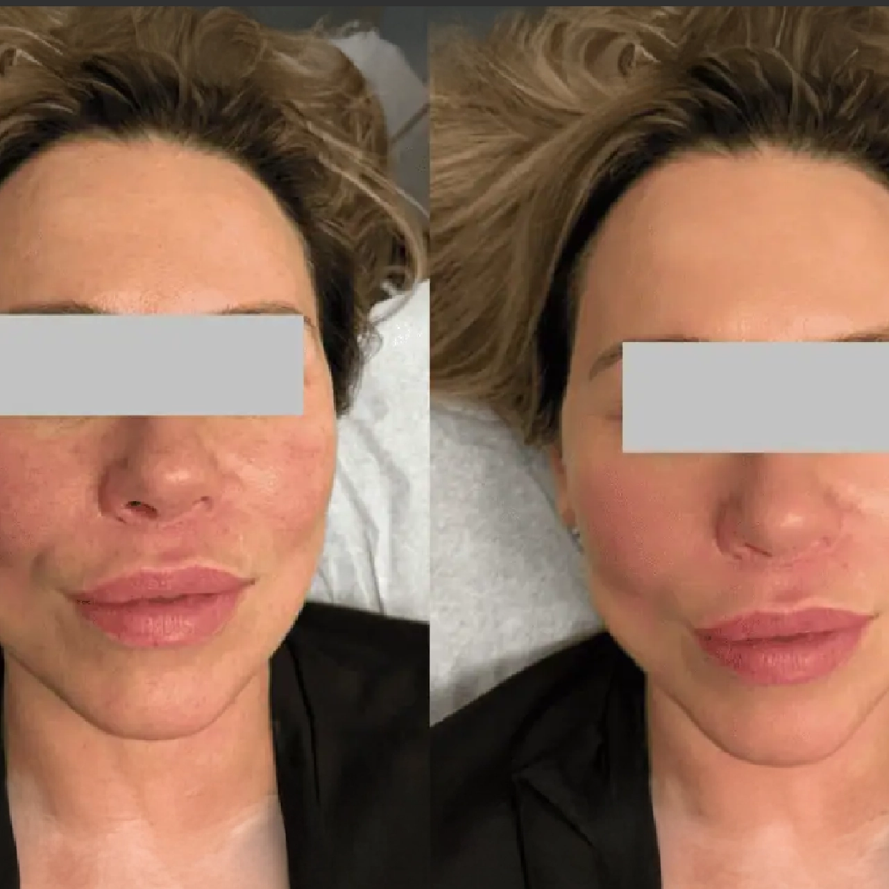 Aerolase® Neo Laser 3