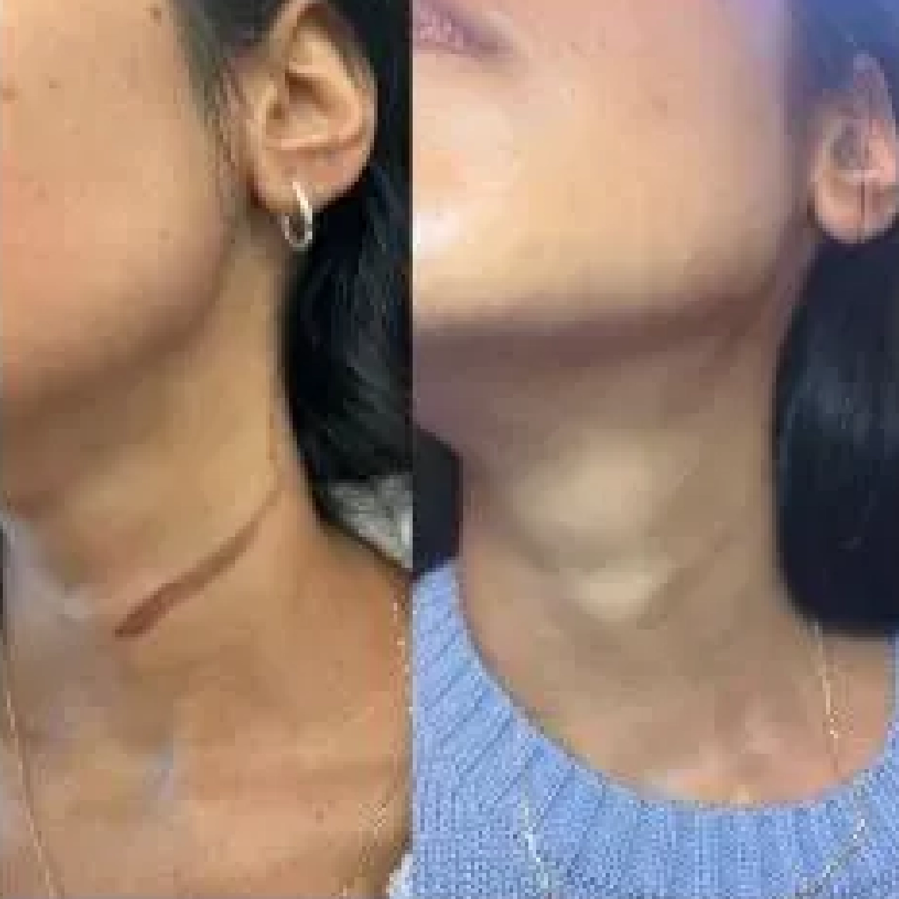 Aerolase® Neo Laser 4