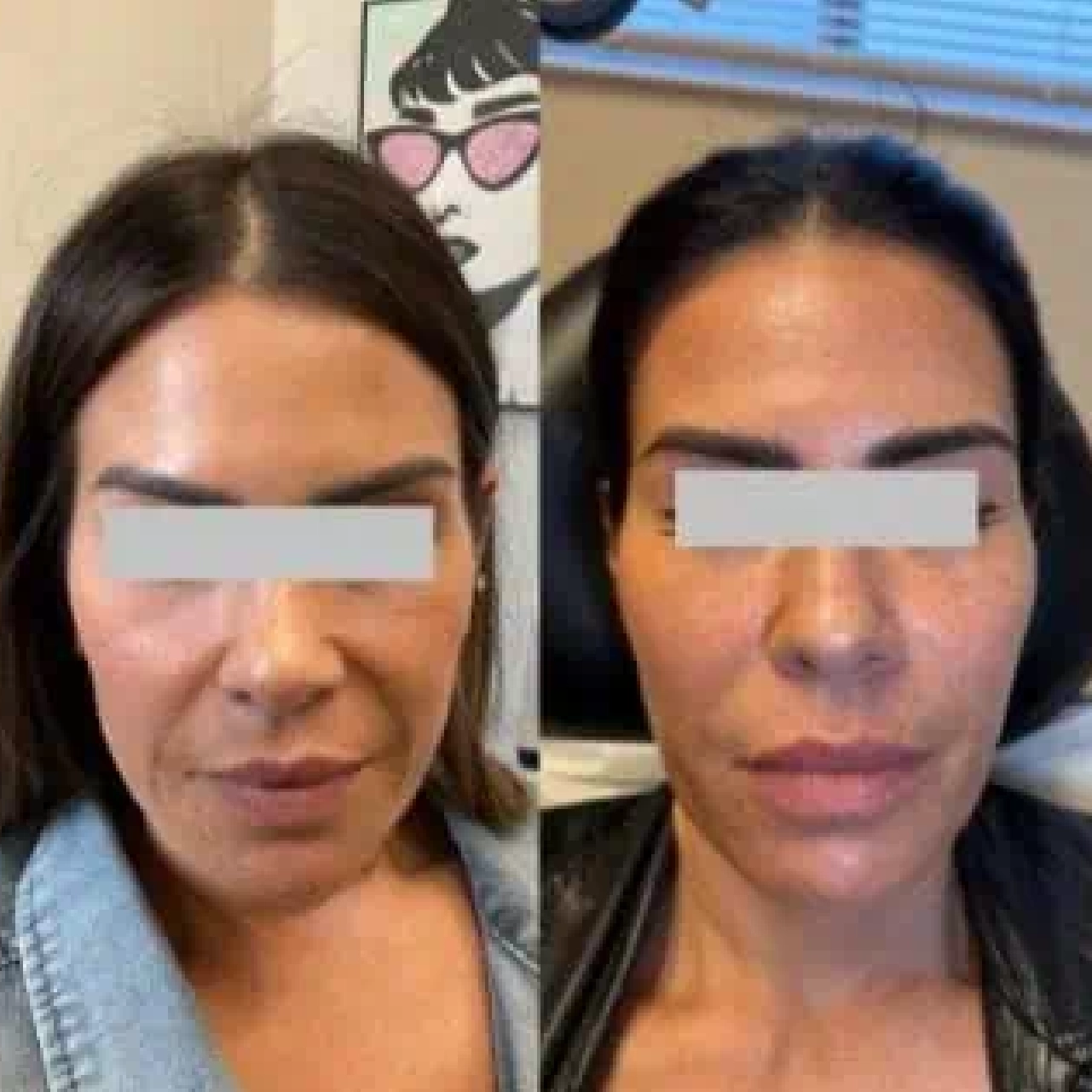 Aerolase® Neo Laser 5