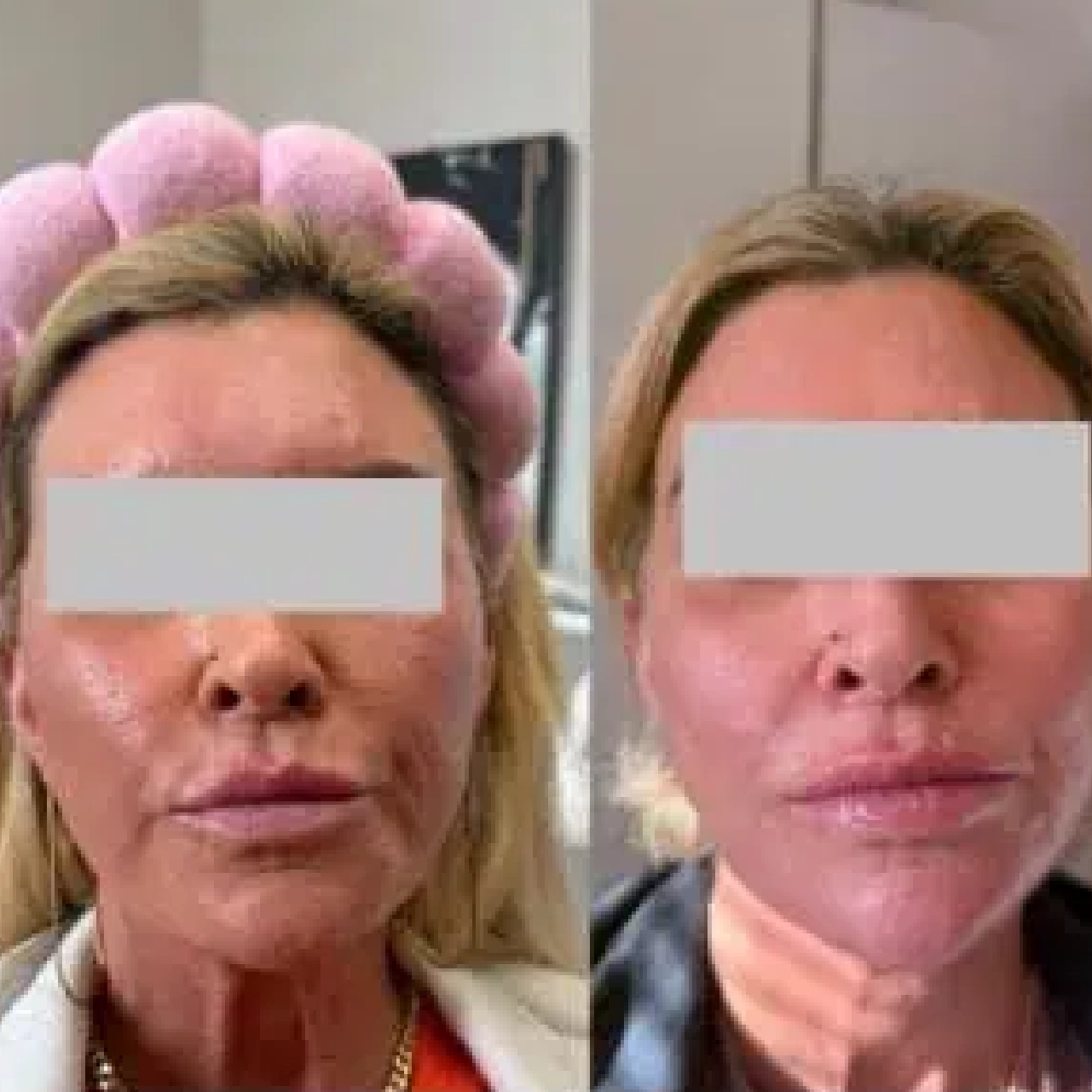 Aerolase® Neo Laser 6