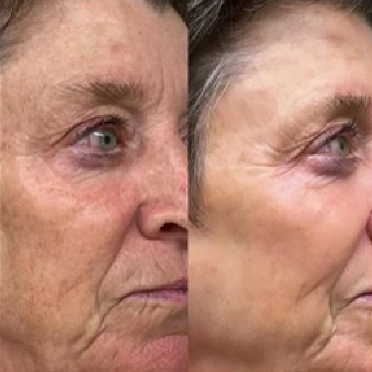 Aerolase® Neo Laser 7