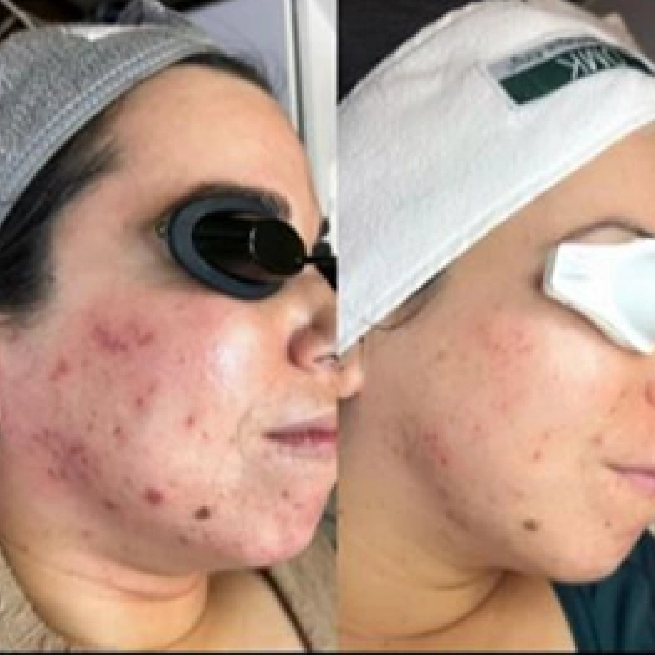 Aerolase® Neo Laser 8