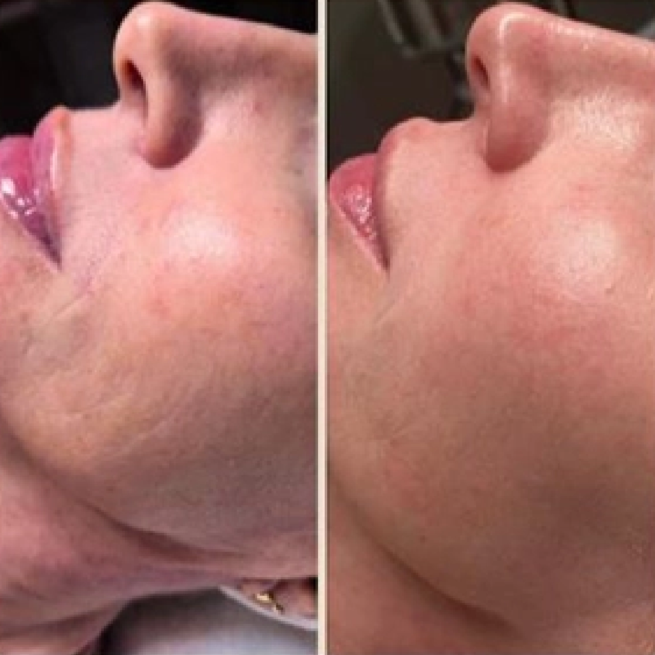 Aerolase® Neo Laser 9