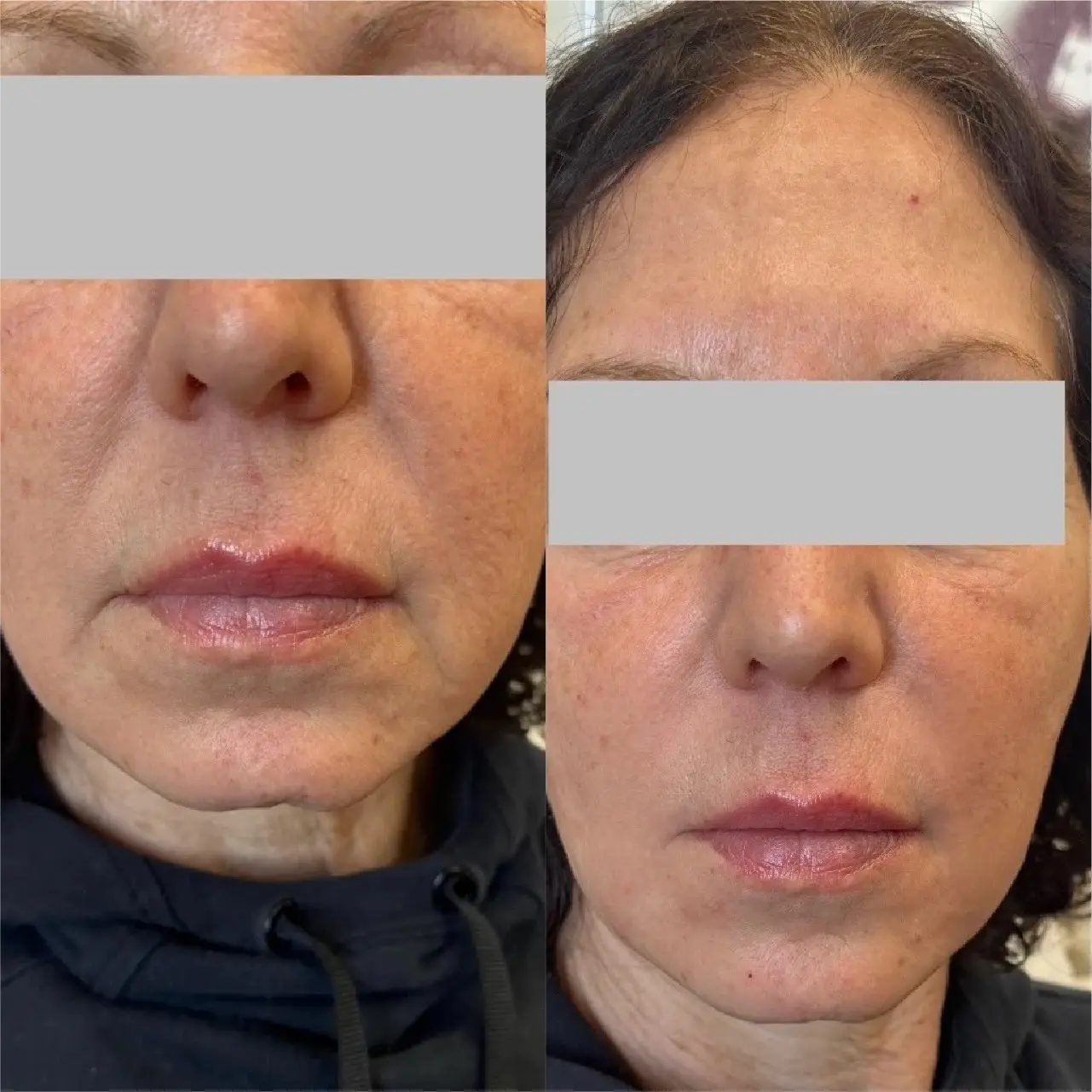 DermalFillers1