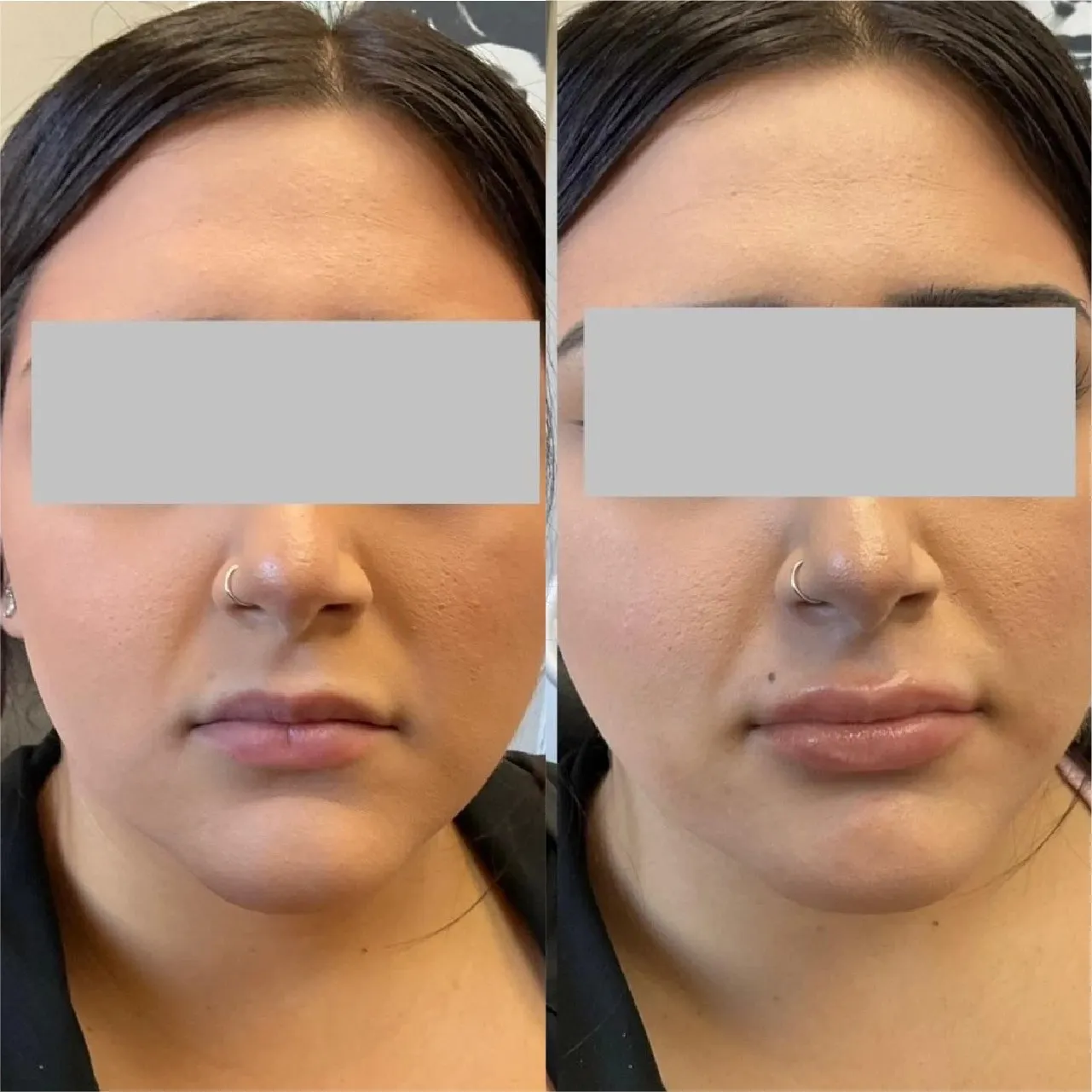 DermalFillers3