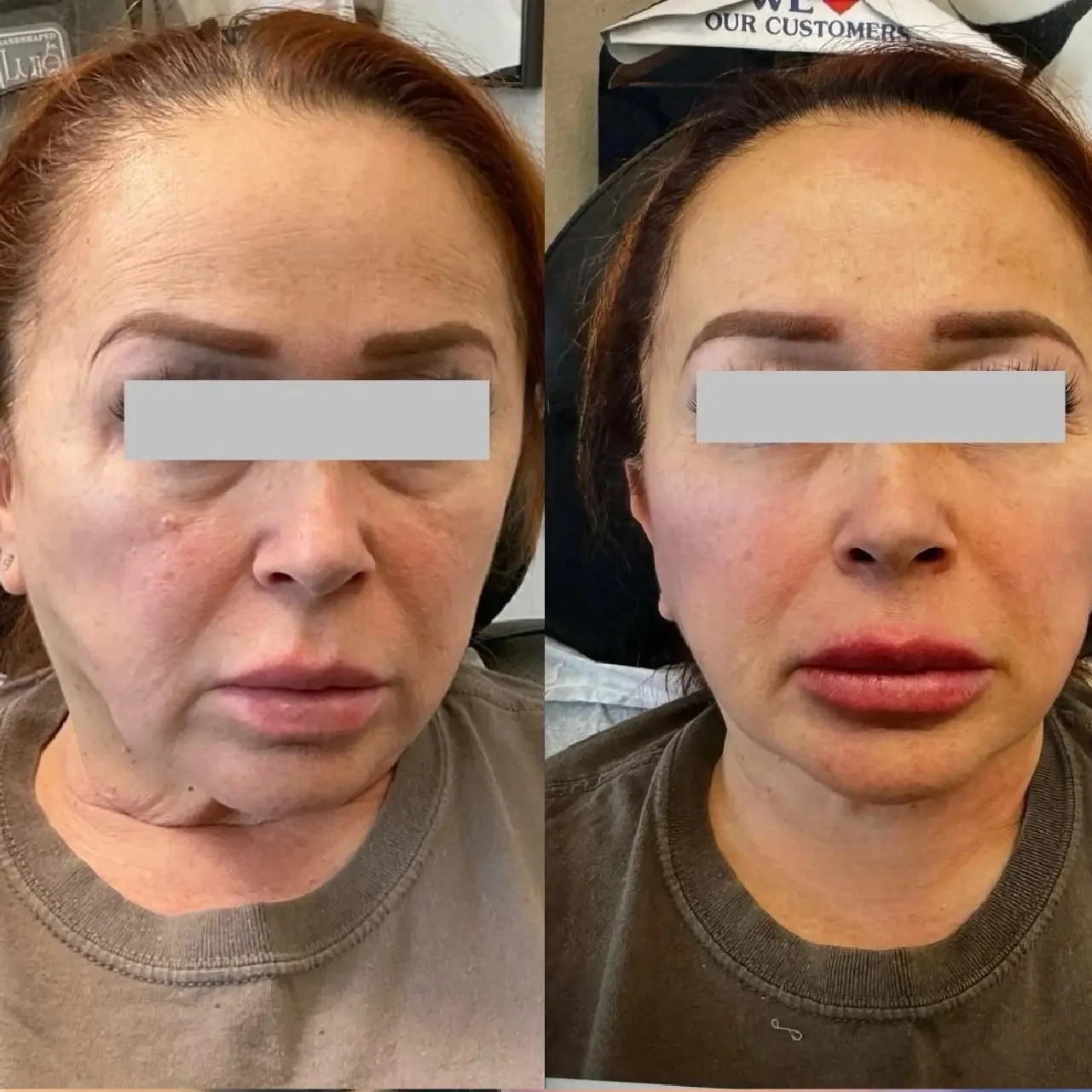 FacialBalancingwithFillers1