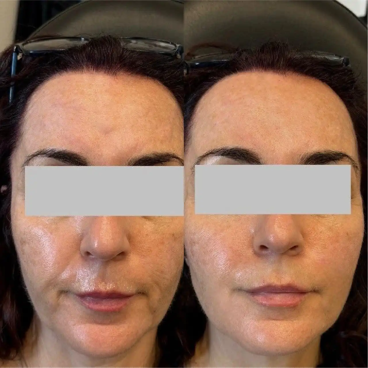 FacialBalancingwithFillers2