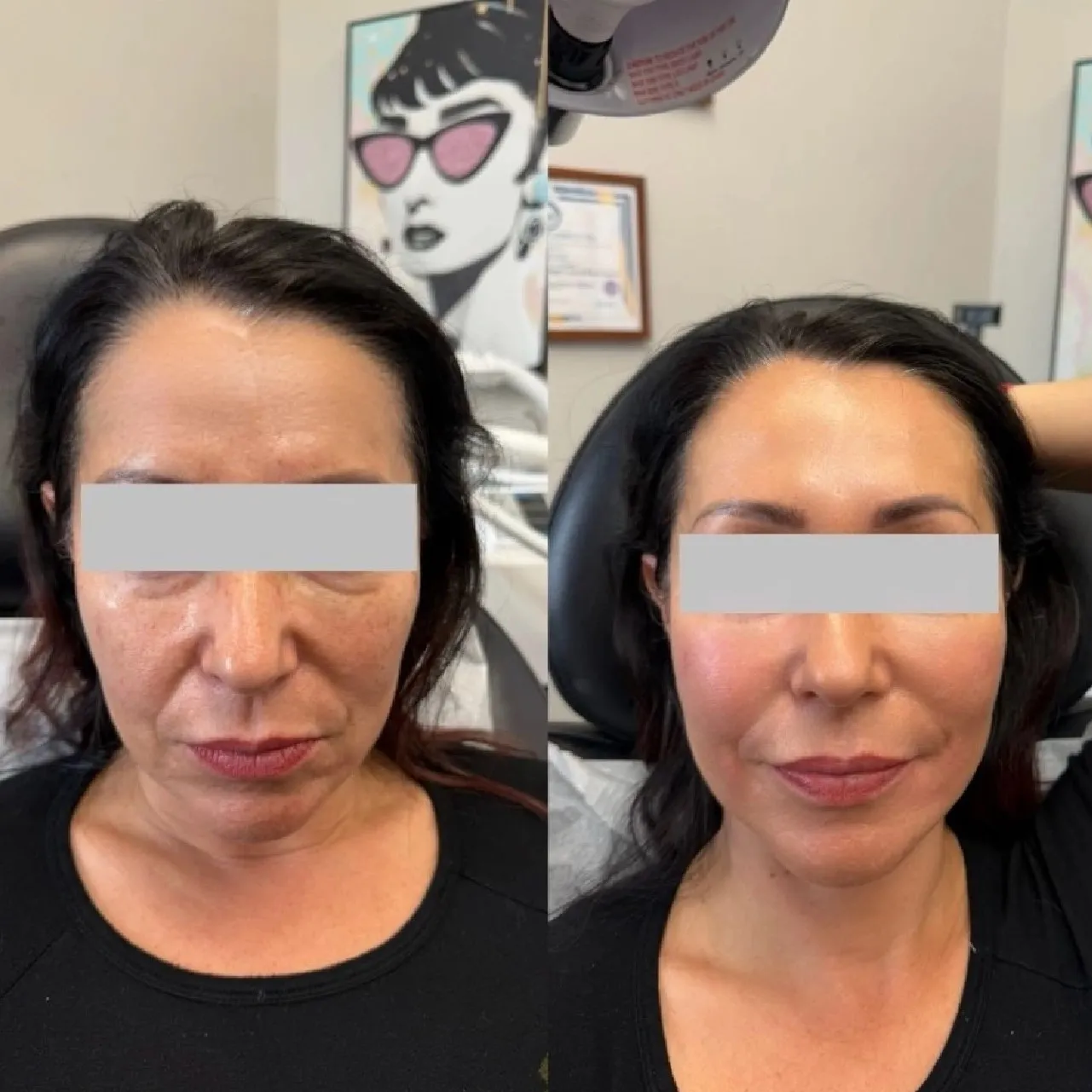 FacialBalancingwithFillers3