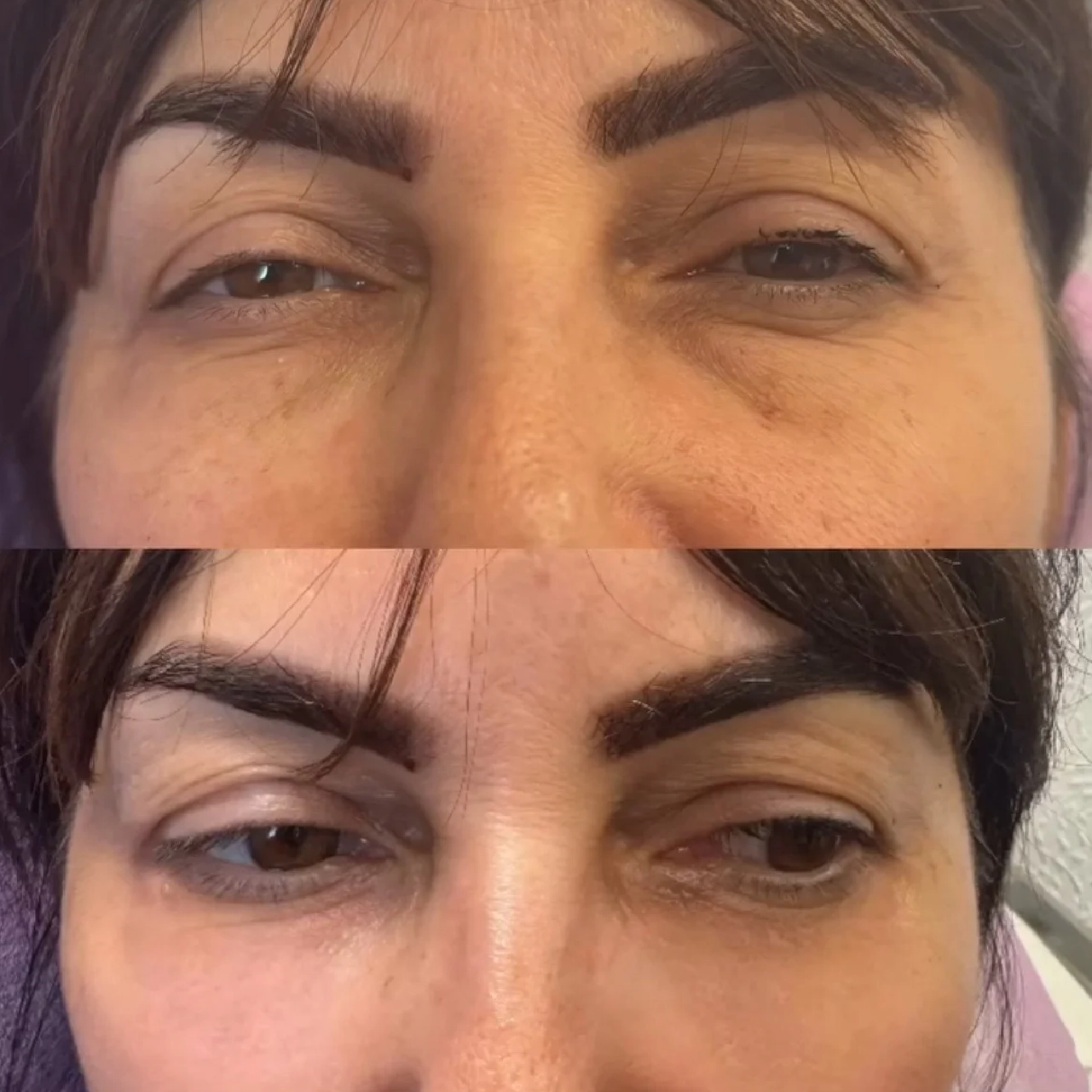 Tear Trough Filler 1