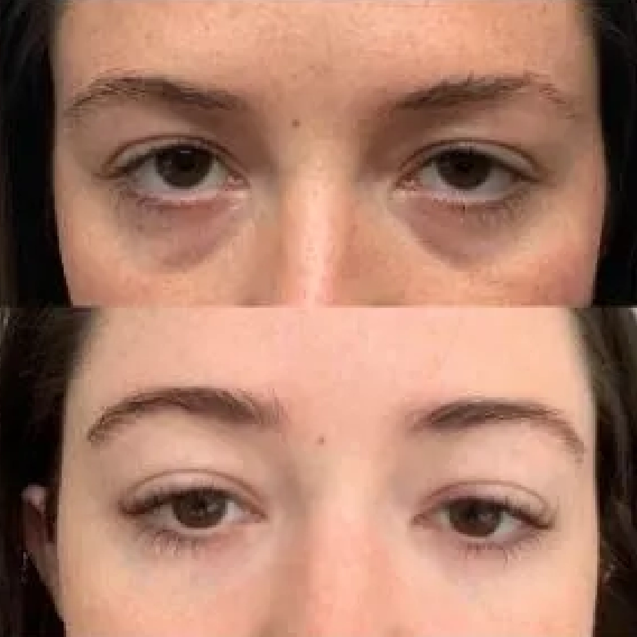 Tear Trough Filler 2