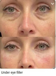 Under eye Filler