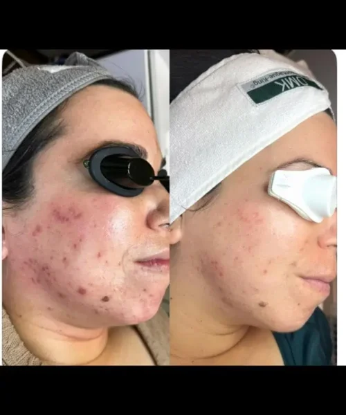 Aerolase® Neo Laser BA eight treatment in San Mateo, CA