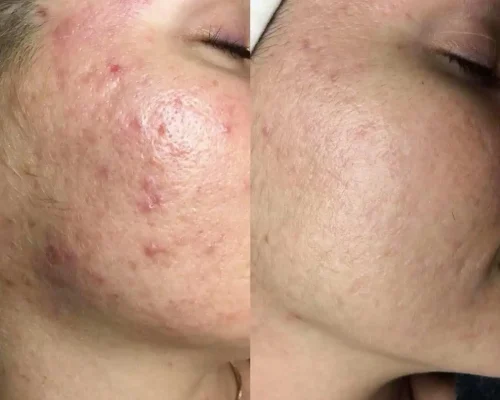 Aerolase® Neo Laser BA five