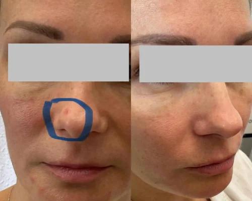 Aerolase® Neo Laser BA four