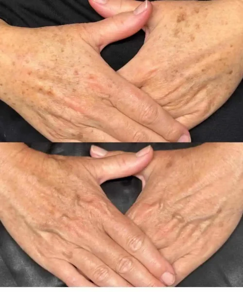 Aerolase® Neo Laser BA one treatment in San Mateo, CA