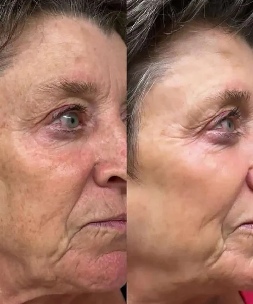Aerolase® Neo Laser BA seven treatment in San Mateo, CA