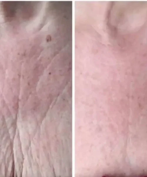 Aerolase® Neo Laser BA six treatment in San Mateo, CA