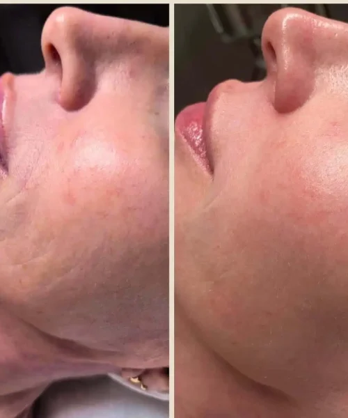 Aerolase® Neo Laser BA three treatment in San Mateo, CA