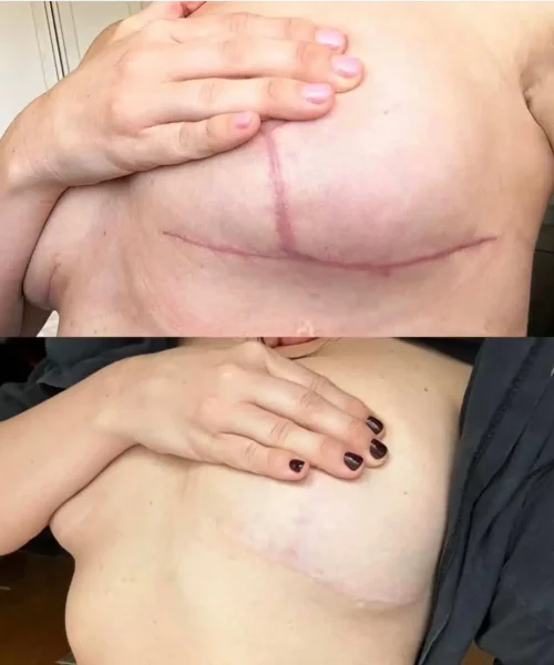 Aerolase® Neo Laser BA two treatment in San Mateo, CA