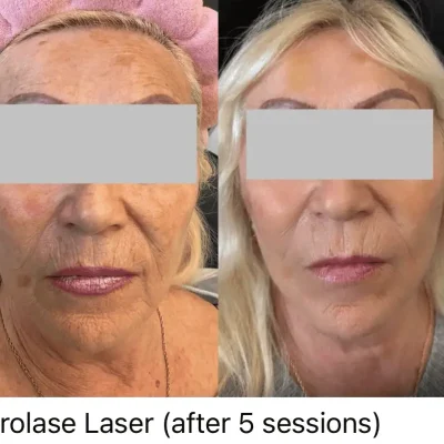Aerolase Laser before and after 2