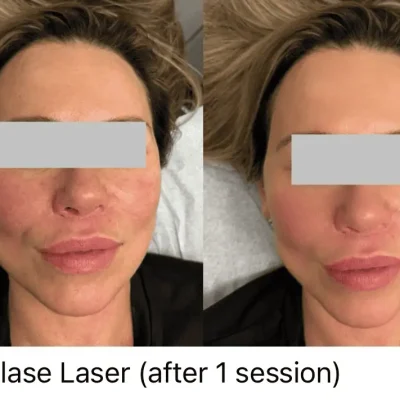 Aerolase Laser before and after 3