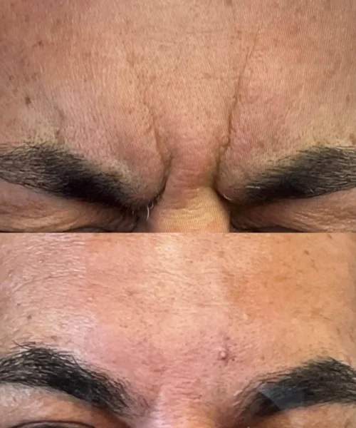 Botox Treatment In San Mateo, CA | Pink Opal Aesthetics
