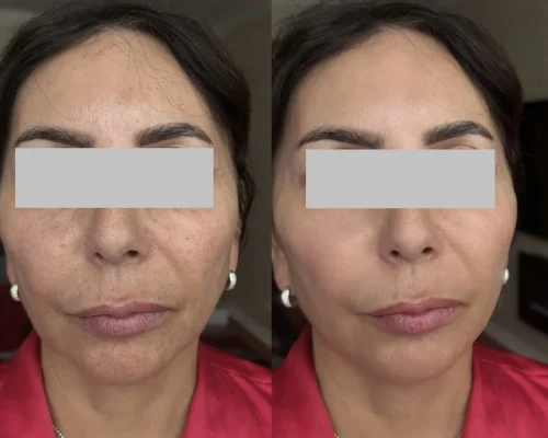 Chemical Peel