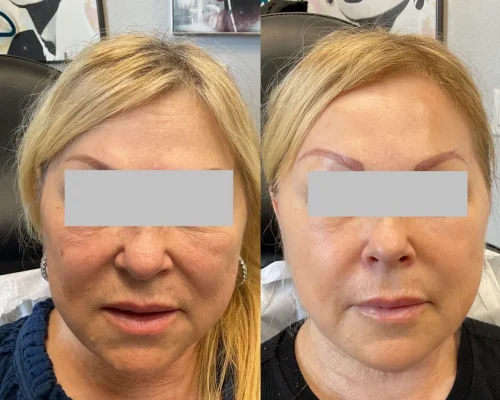 Chemical Peel