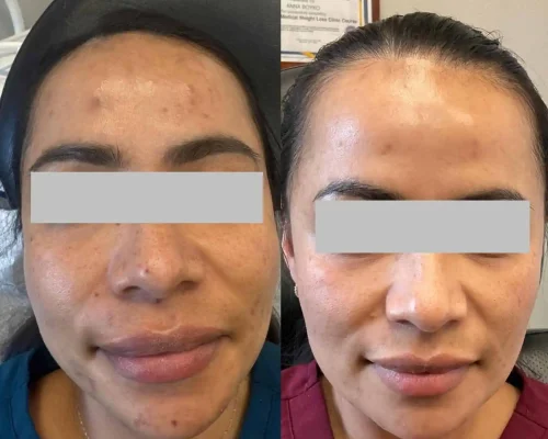 Chemical Peel Treatment By Pink Opal Aesthetics in San Mateo, CA