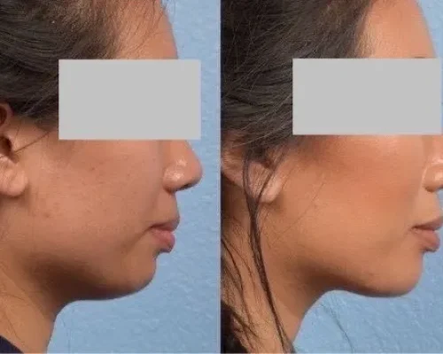 Chin filler 1