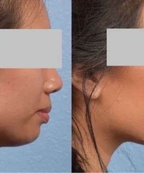 Chin filler 1