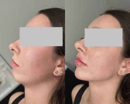 Chin filler