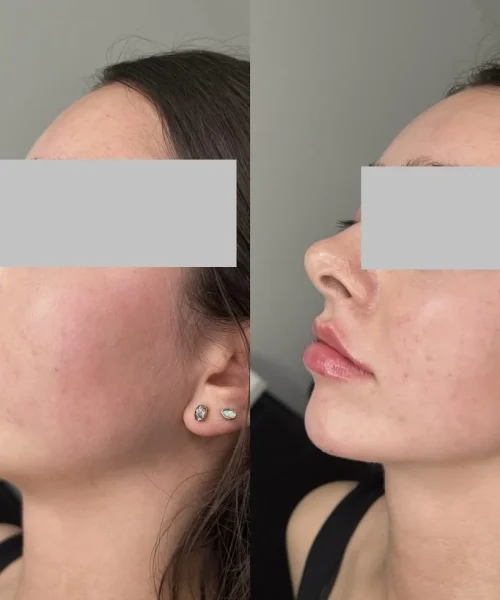 Chin filler