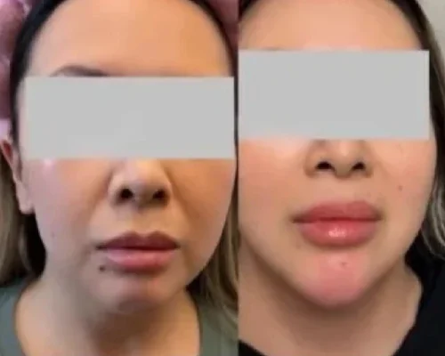 ChinAugmentationandJawlineFiller