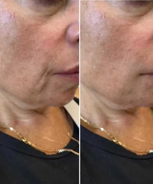 Dermal Fillers