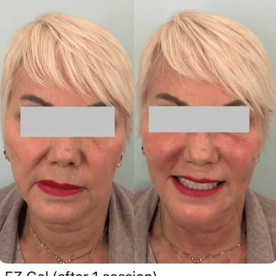 EZ Gel Before and After