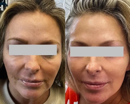 Facial Balancing
