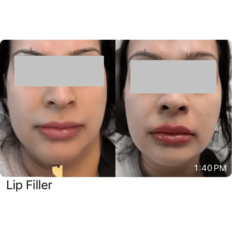LIp Filler Before and After (1)