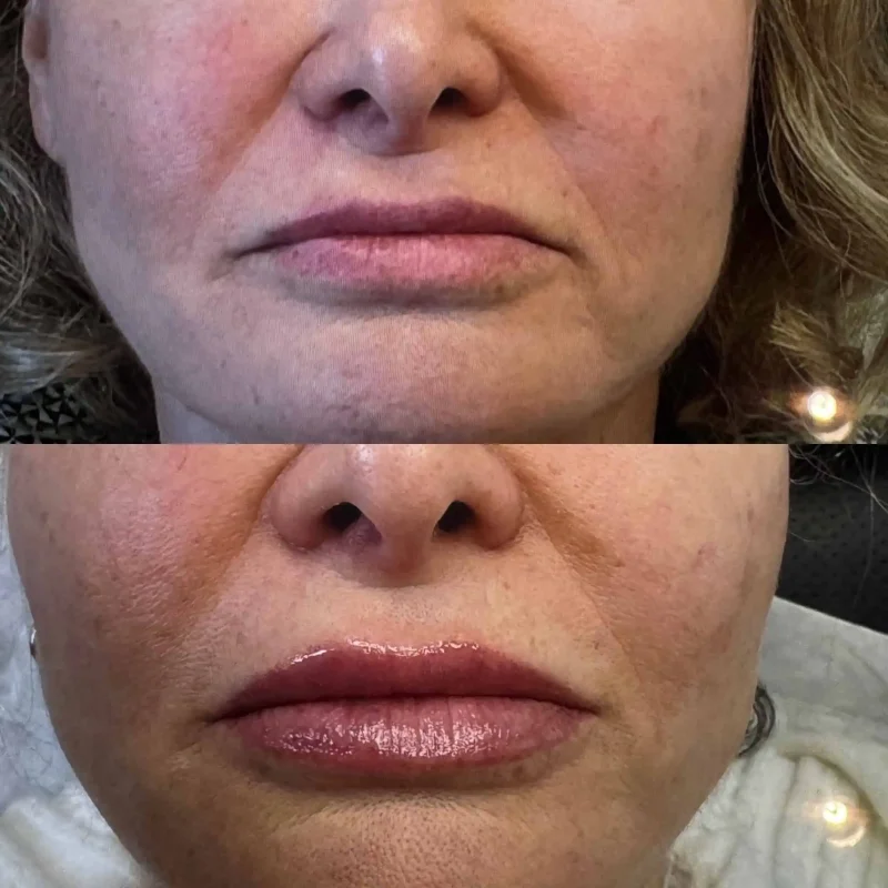 Lip Filler (1)