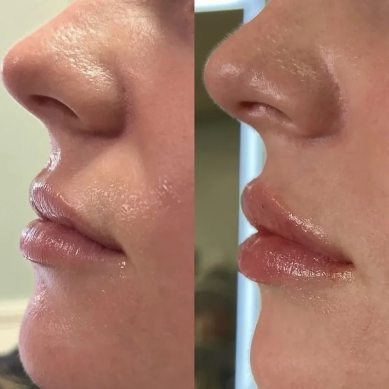 Lip Filler (1) Treatment in San Mateo, CA by Pink Opal Aesthetics