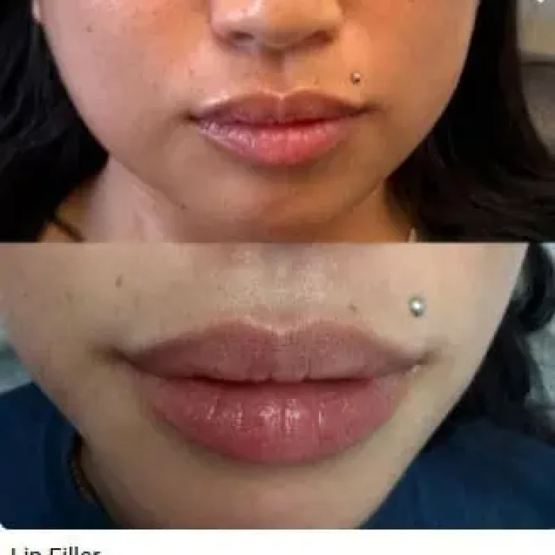 Lip Filler-BA