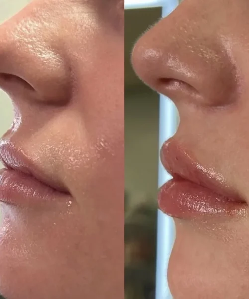 Lip filler 1