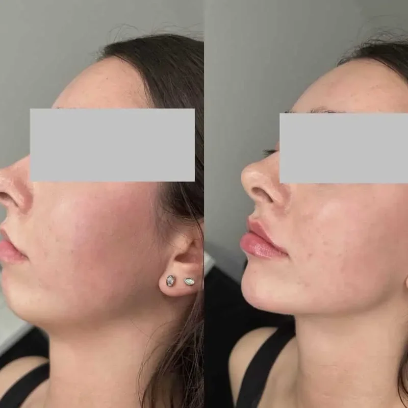 Lip filler