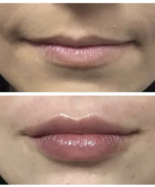 Lip filler