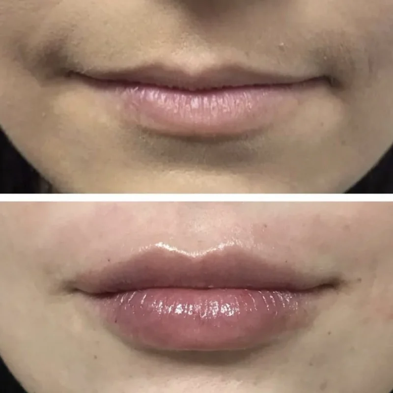 Before After Lip filler Treatment in San Mateo, CA by Pink Opal Aesthetics