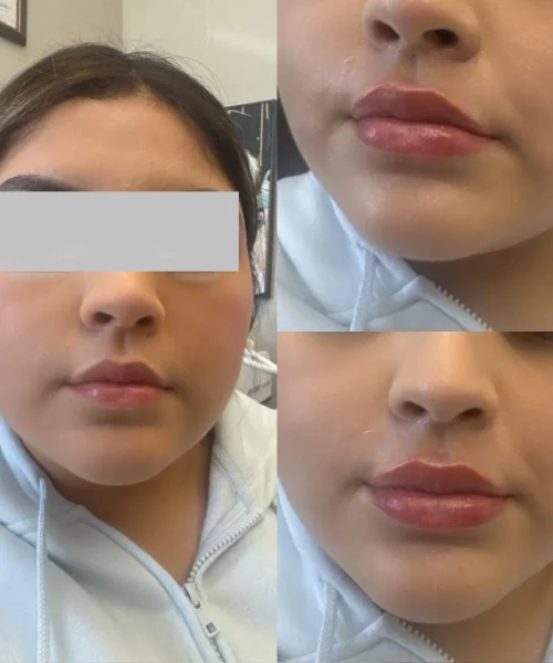 Lip fillers - a