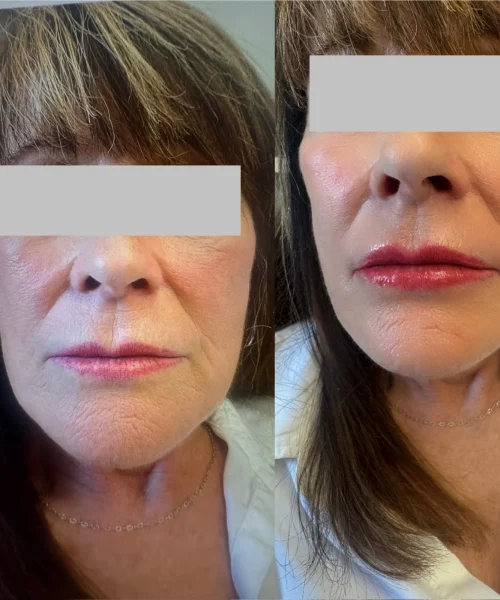 Lip fillers - d