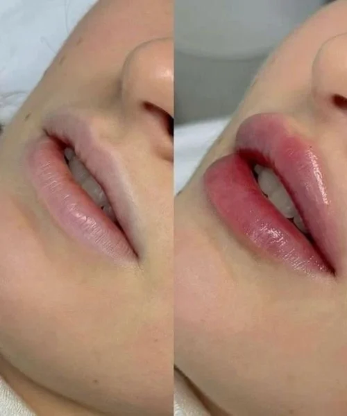 Lip fillers - e