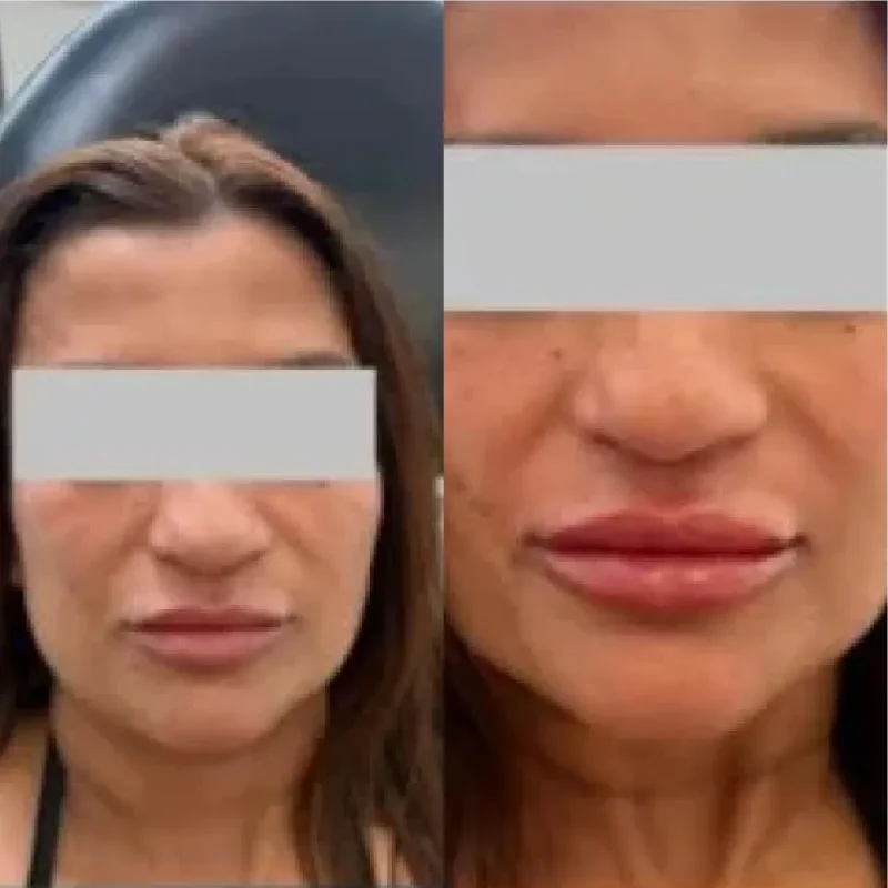 LipAugmentationwithFiller